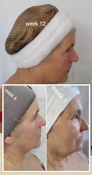 zone-facelift4-300x570